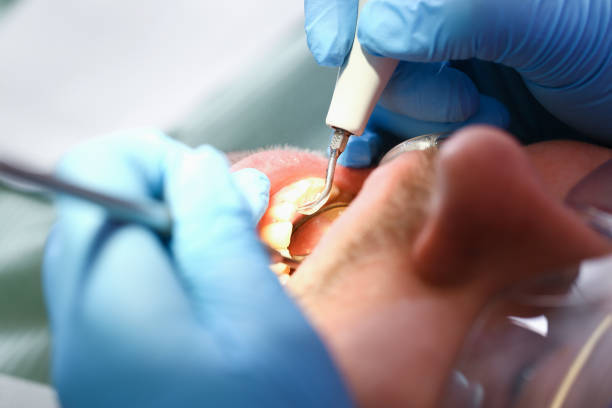 Best Emergency Tooth Extraction in Genoa, IL